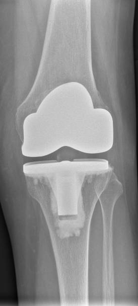 X-ray of knee joint replacement