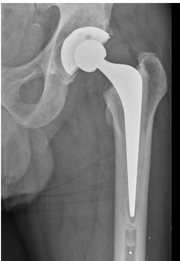 X-ray of hip joint replacement